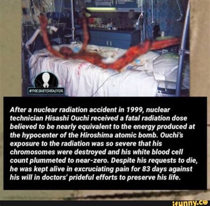 The Enduring Legacy Of Hisashi Ouchi: A Case Study In Radiation Exposure